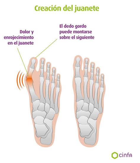 ¿cómo Se Pueden Corregir Los Juenetes Cinfasalud