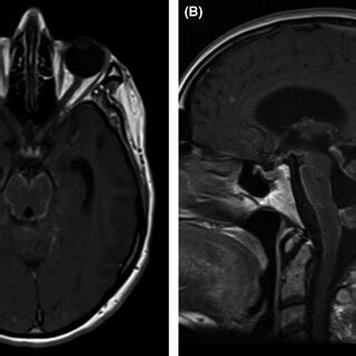 Transverse A And Sagittal B Contrastenhanced T Weighted Images Show