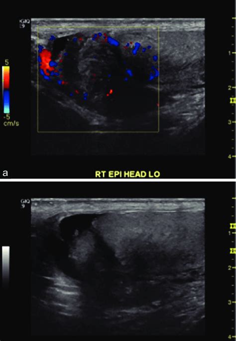 A Ultrasound Image With Color Flow Doppler Of Enlarged Mass In Right