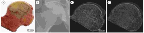 Bone Microarchitecture Analysis Of Necrotic Femoral Head In Early And