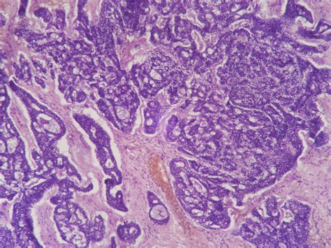 Adenoid cystic carcinoma – Histopathology.guru