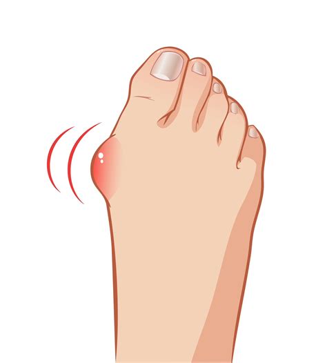 Bunions Symptoms And Causes Podiatrists Housecalls Chicago