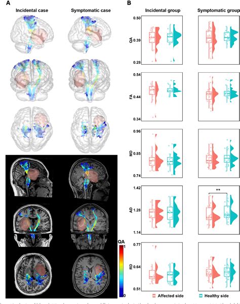 Figure From A Preliminary Study On Corticospinal Tract Morphology In