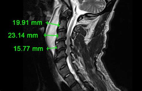 Cervical Mri Anatomy