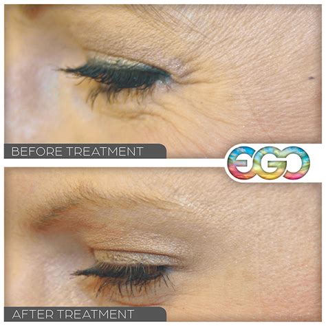 Anti Wrinkle Treatment EGO Beauty Westminster London