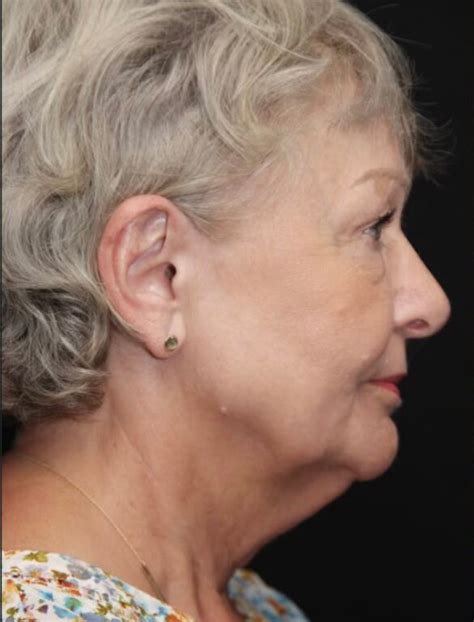 Patient Facelift Solomon Facial Plastic