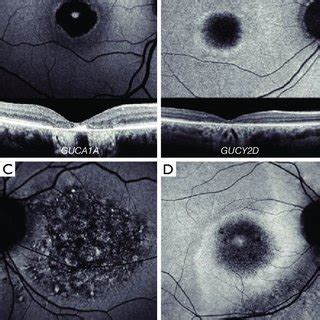 Retinal Imaging Of Rod Cone Dystrophies A Autosomal Dominant