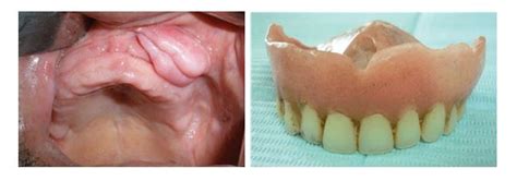 Denture Induced Fibrous Hyperplasia