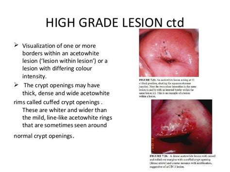 Colposcopy2 1