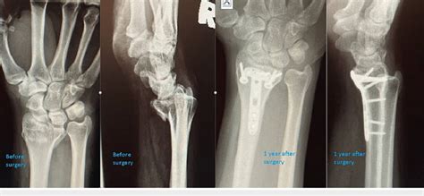 An Example Of Ao 23c3 Distal Radius Fracture Treated With Volar Rim Download Scientific Diagram