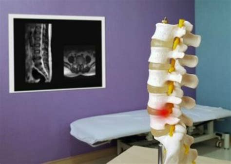 Lumbar Spinal Stenosis Causes Symptoms Diagnosis And Treatment Dr Rajat Mahajan Dr Rajat