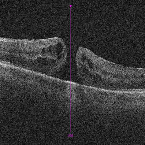 PDF A Microbubble Of Gas As An Early Indication Of Macular Hole