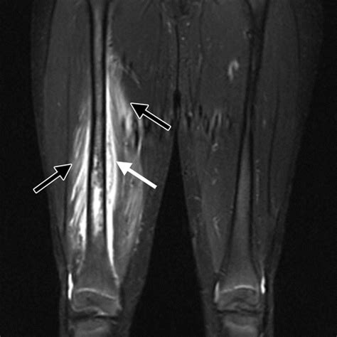 Hematogenous Osteomyelitis In Infants And Children Imaging Of A