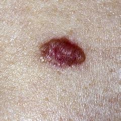 Basalioma O Carcinoma A Cellule Basali Bcc Issalute