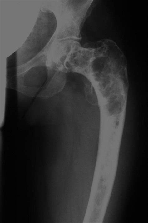 Fibrous Dysplasia Shepherds Crook And Ground Glass Appearance