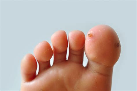 How to Finally Get Rid of Your Foot Warts - Trinity Foot Center