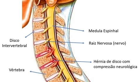 H Rnia De Disco Cervical Dr Ricardo Teixeira