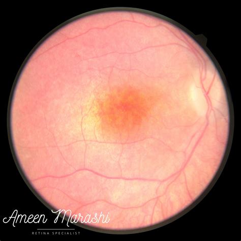 Cone Rod Dystrophy An Example Of Rpe Atrophy Due To Cone Rod Dystrophy