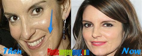 Tina Fey Plastic Surgery Before and After | Tina Fey Face Scar | | Plastic Surgery Magazine