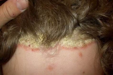 Severe scalp psoriasis images | Symptoms and pictures