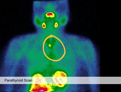 Parathyroid – Dr. Sudhi Agarwal Kamboj