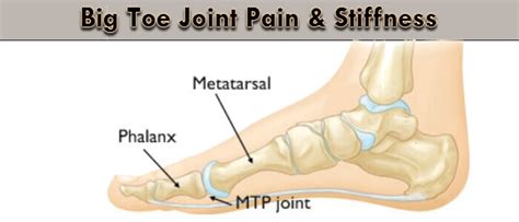 Big Toe Joint Pain & Stiffness - LondonFootandAnkleSurgery.co.uk