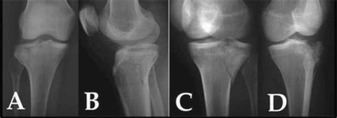 Radiographic Projections For Diagnosis Of Tibial Plateau Fractures A Download Scientific