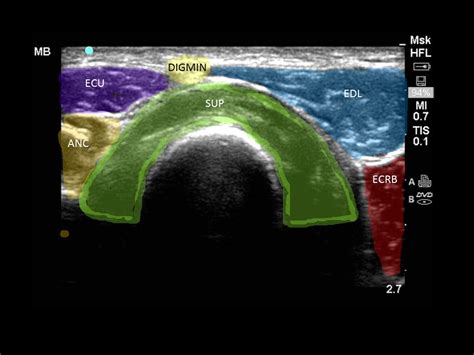 Elbow Extensors Identified On Ultrasound Youtube