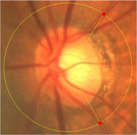 measurement  peripapillary retinal arteries angle praa left eye