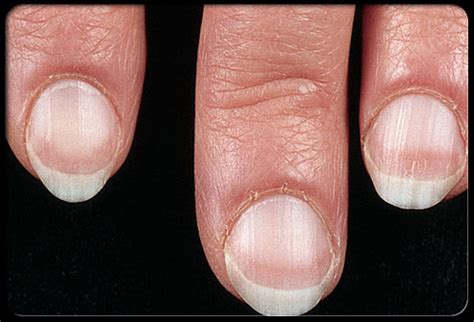 What causes my nails to split - Awesome Nail