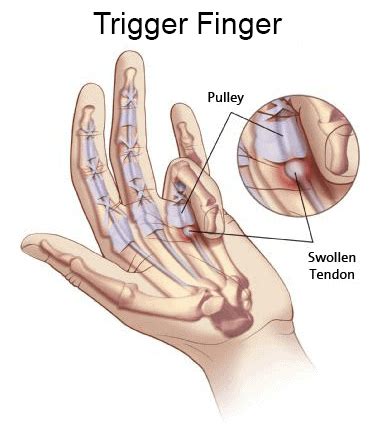 Trigger Finger FORM Hand Wrist Elbow Institute