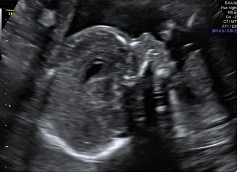 Ultrasound At 21 Weeks Revealing A Significant Improvement Of Amniotic