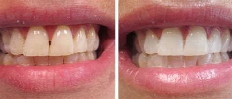 Teeth Whitening In Delhi Cost Effective Teeth Whitening Treatment