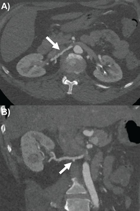 Optimal Surveillance And Treatment Of Renal And Splenic Artery Aneurysms Cleveland Clinic