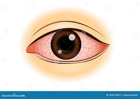 Eye Redness Symptom Of Asian People Stock Vector Illustration Of