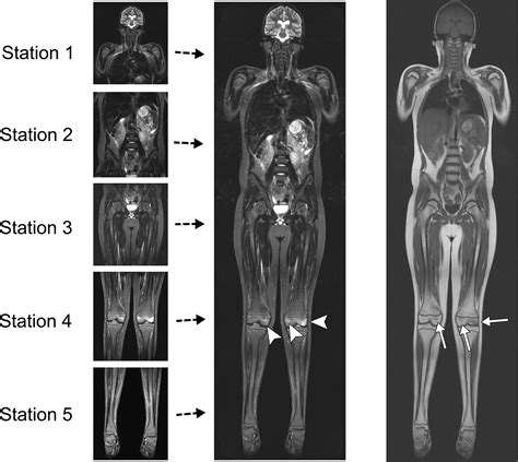 Current And Emerging Roles Of Whole Body Mri In Evaluation Of Pediatric