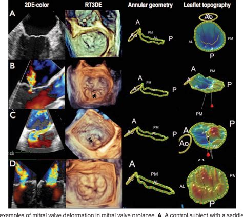 Quantitative Analysis Of Mitral Valve Morphology In Mitral Valve