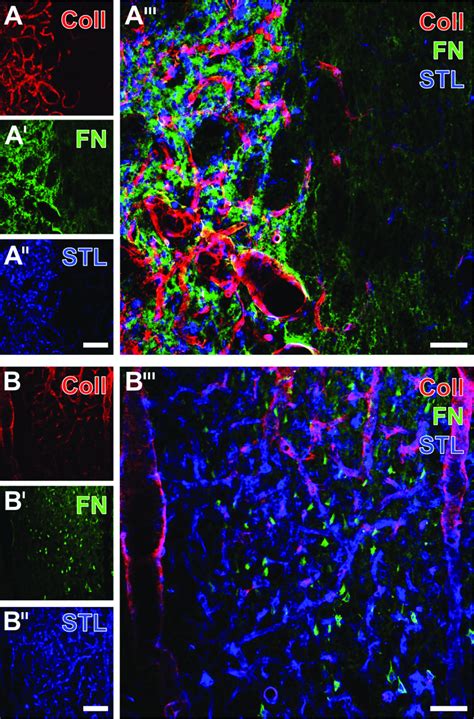 Triple Fluorescence Staining Of Fibronectin FN Collagen IV Coll