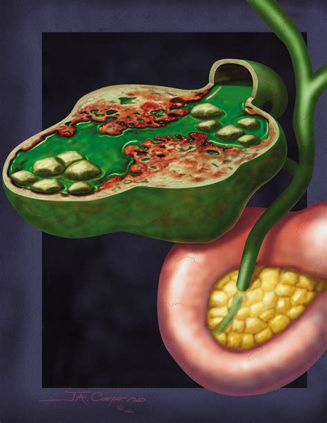 Adenomyomatous Hyperplasia Of The Gallbladder Radiographics