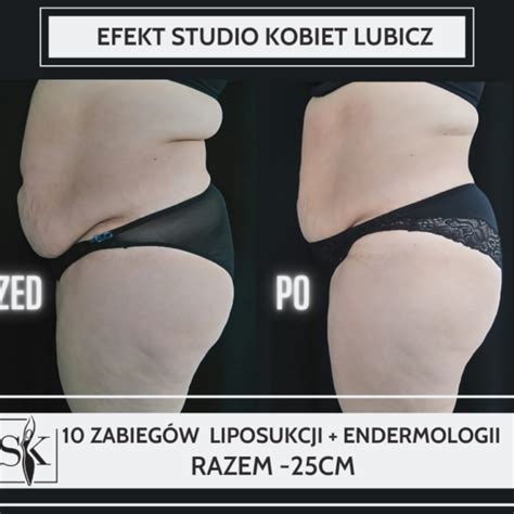 Endermologia Toru Usuwanie Cellulitu Modelowanie Sylwetki