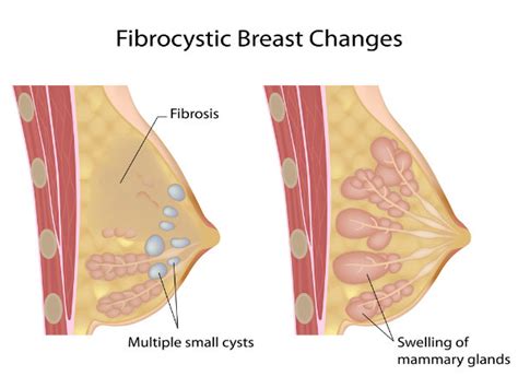 Treatment Options For Fibrocystic Breast Disease Boldsky