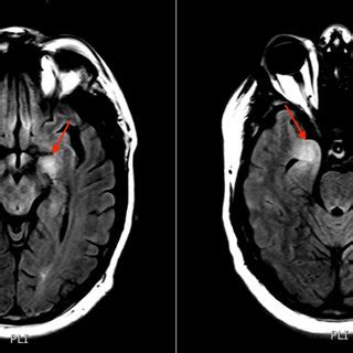 Fluid Attenuated Inversion Recovery Magnetic Resonance Imaging Of The