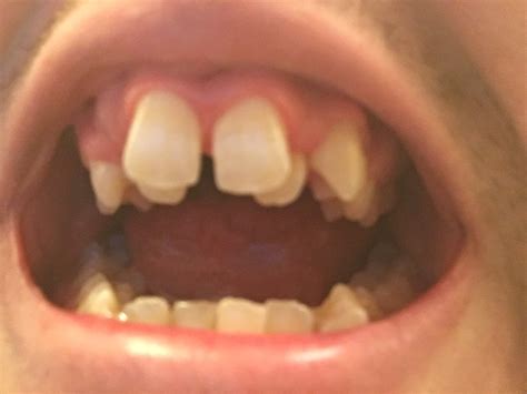 Severely Crooked Teeth And Ive Given Up Hope Advice Rdentistry