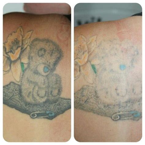 Before and after 1 session at Remove Inc Laser Tattoo Removal. Tattoo ...