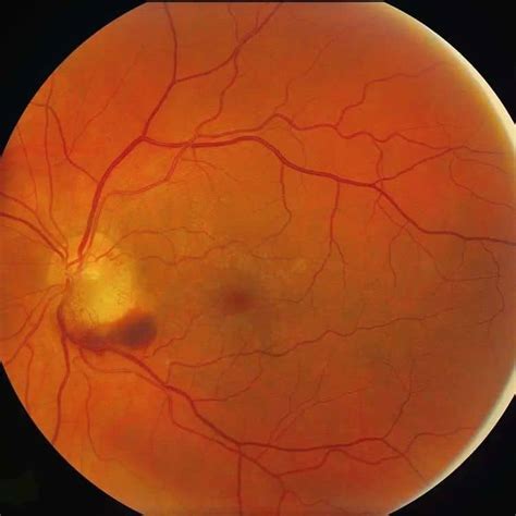 Retinal Capillary Haemangiomas Peripheral And Juxtapapillary Outlook Eye Specialists