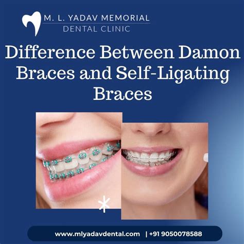 Difference Between Damon Braces And Self Ligating Braces