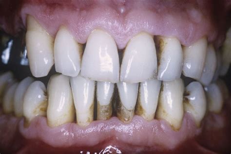 Periodontitis Trastornos Odontológicos Manual Msd Versión Para