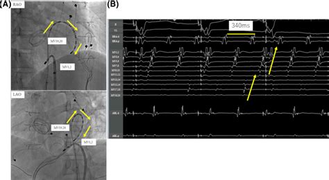 Intracardiac Electrophysiology Fluoroscopic View Of Intracardiac