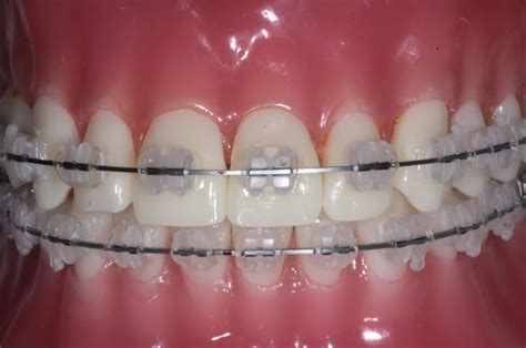 Fixed Braces Available Treatments Riverhouse Orthodontic Practice