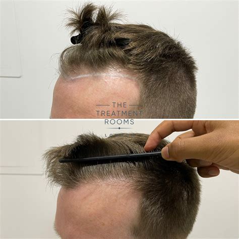 A Guide To High Density Hair Transplantation Hair Transplant Specialists Treatment Rooms London